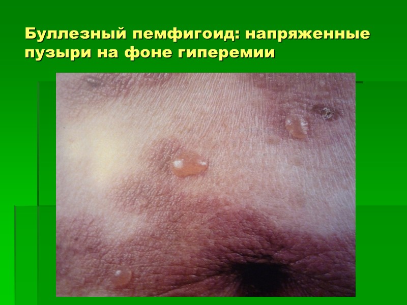 Буллезный пемфигоид: напряженные пузыри на фоне гиперемии